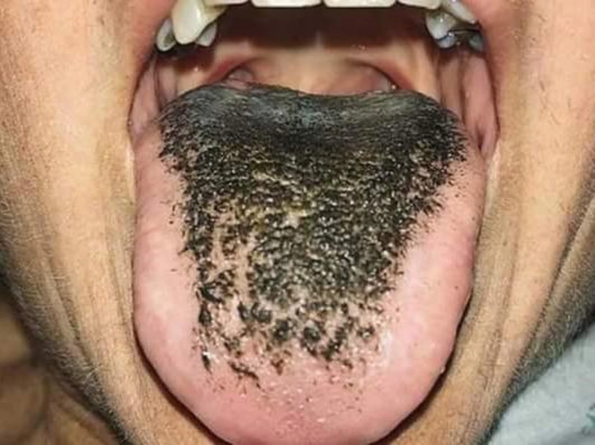 Proč se jazyk po kávě barví dočerna a kdy byste měli zbystřit - image 1