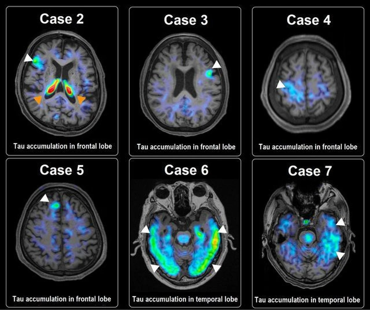 Proč se vyplatí brát vážně pocity nejistoty po čtyřicítce: Studie po 25 letech odhalila souvislost s mozkem - image 1