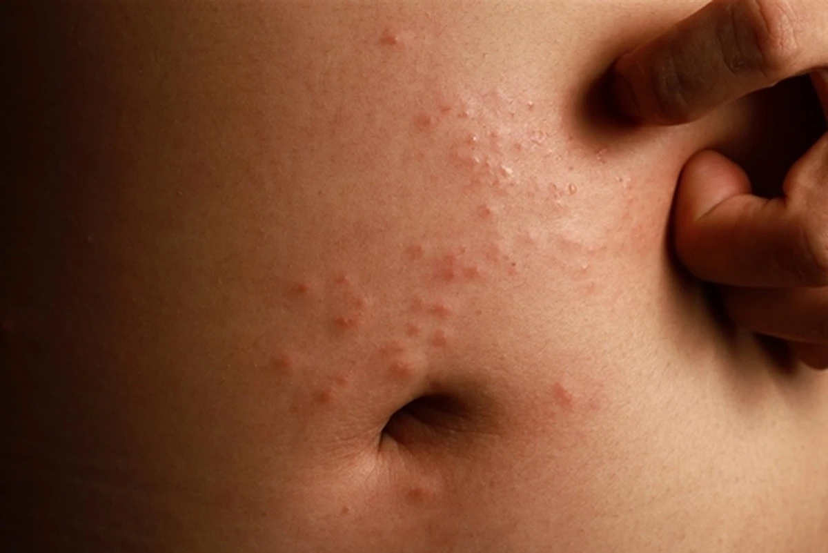 Proč zkušení lékaři varují před tímto červeným kruhem na kůži